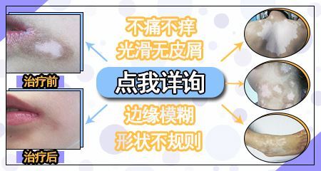 宝宝皮肤出现白斑图片